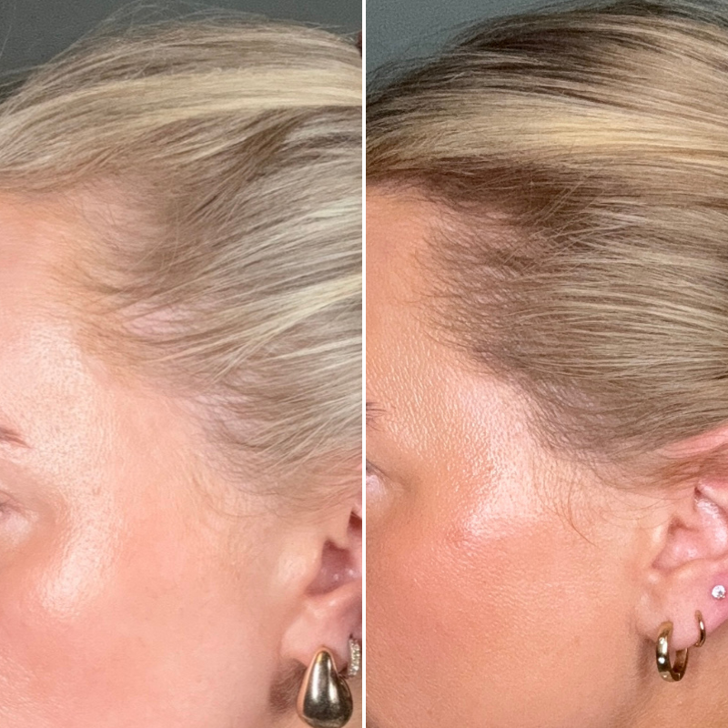 Wat zijn de belangrijkste oorzaken van haaruitval bij vrouwen en is het omkeerbaar?