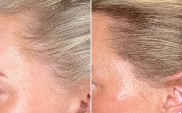 Wat zijn de belangrijkste oorzaken van haaruitval bij vrouwen en is het omkeerbaar?