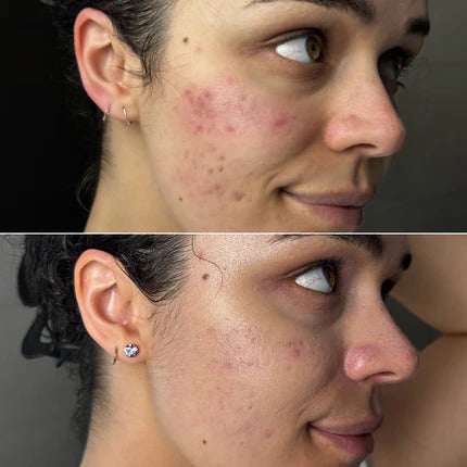Roodlichttherapie: voor en na – foto’s en resultaten