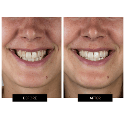 CurrentBody Skin Teeth Whitening Kit