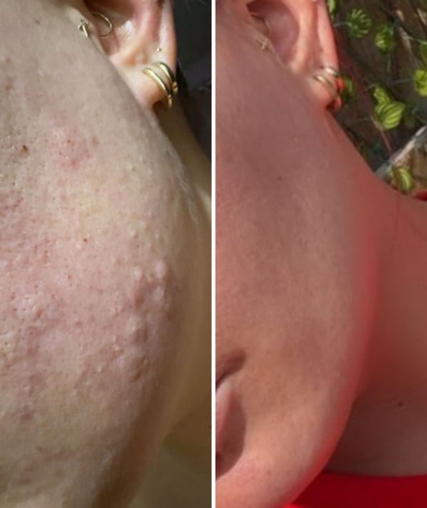 Acne & vlekken