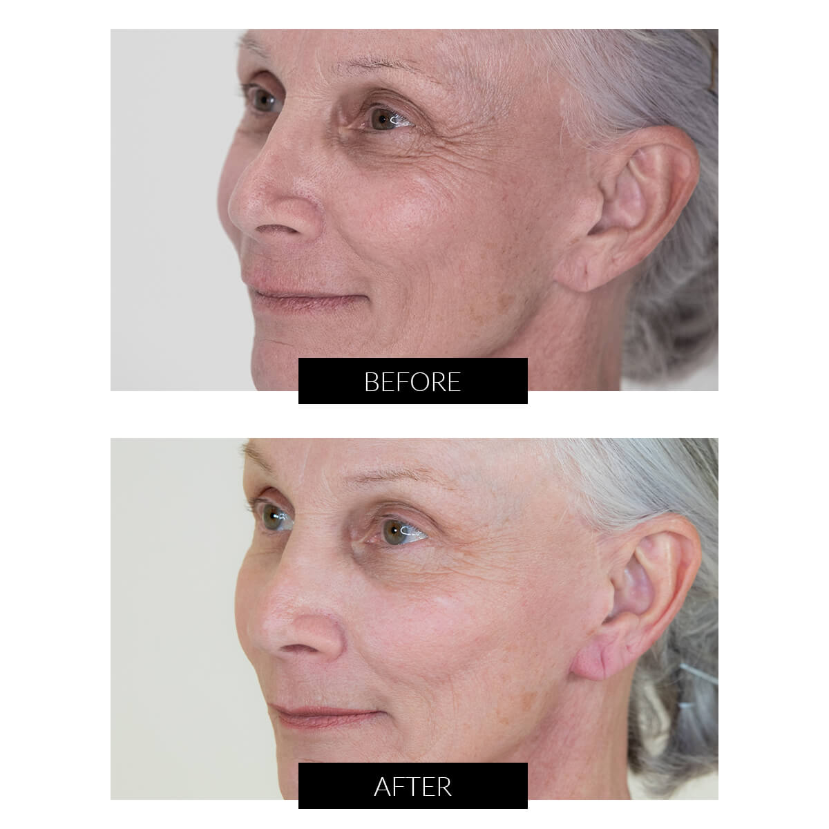 Nira laser deals