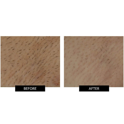 SmoothSkin Bare+ Ultrafast IPL Device Summer 2022 Collection