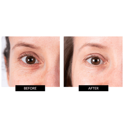 CurrentBody Skin LED Eye Perfector & 5 Eye Hydrogel Masks