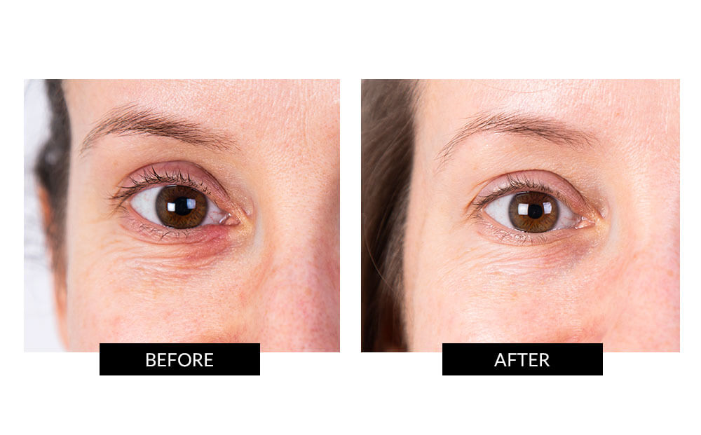 Nira laser deals