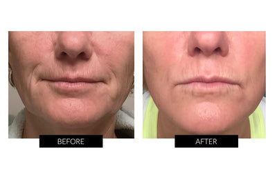 Trophy Skin MiniMD Handheld Portable Microdermabrasion Device