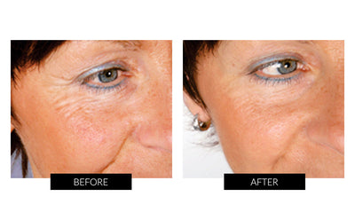 Trophy Skin MicrodermMD Home Microdermabrasion System
