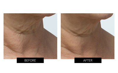 Trophy Skin MiniMD Handheld Portable Microdermabrasion Device