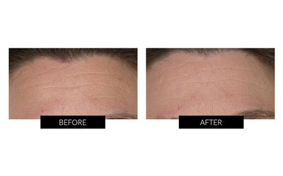 Trophy Skin MicrodermMD Home Microdermabrasion System